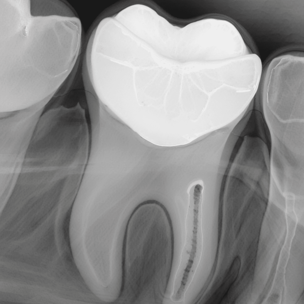 Рентген зубов