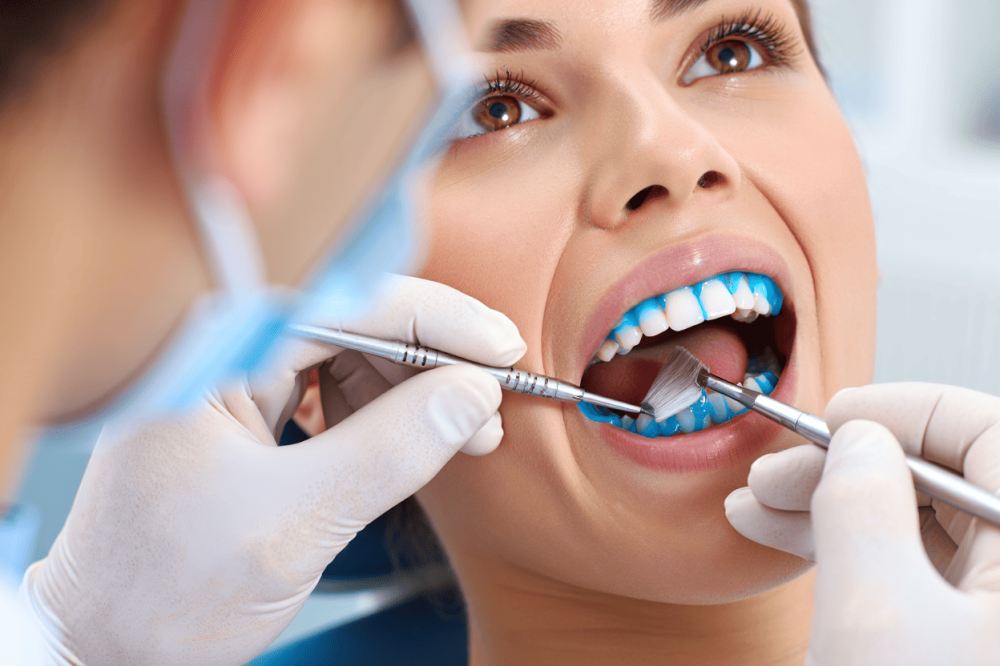 Профессинальное отбеливание зубов